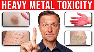 4 Skin Signs That Reveal Heavy Metal Toxicity [upl. by Yonita]