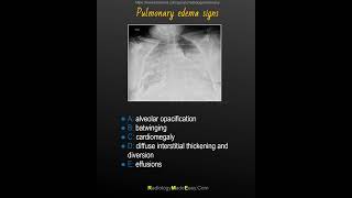 Radiographic signs of pulmonary edema  mnemonic [upl. by Shurlock]