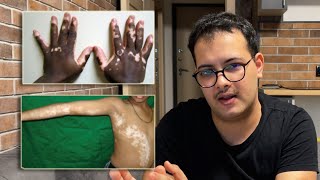 Who Can Use OPZELURA  Segmental VS Non Segmental Vitiligo [upl. by Hael245]