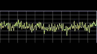 Bone Diseases  Rife Frequencies [upl. by Reppiks]