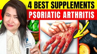 4 Scientific Supplements to Improve Psoriasis Symptoms [upl. by Jo Ann231]