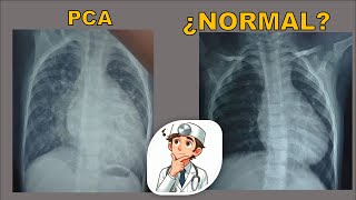 Radiografía en Cardiopatías Congénitas  PCA  Conducto Arterioso [upl. by Akeme]