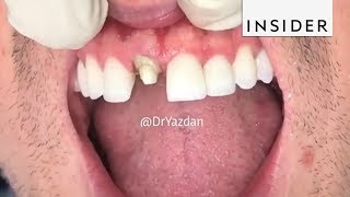 How Dentists Create Tooth Veneers And Crowns [upl. by Yesteb]