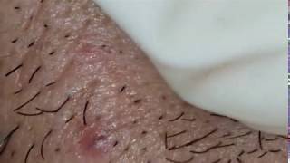 Biggest Ingrown Hair infected Removed on face [upl. by Rabush]