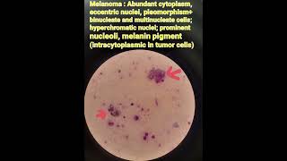 Cytology smear skinMelanomapathologymedical [upl. by Okiek]