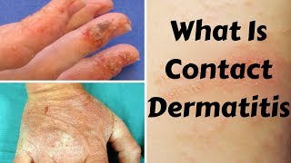 What Is Contact Dermatitis [upl. by Aniat]