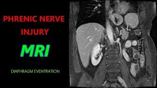 PHRENIC NERVE INJURY MRI  Paralyzed Diaphragm  Eventration [upl. by Airat]