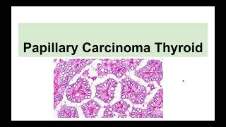 Papillary Carcinoma Thyroid [upl. by Queston335]