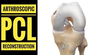 Arthroscopic PCL Posterior Cruciate LigamentReconstruction with Hamstring Graft [upl. by Corson]