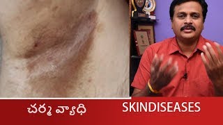 HOW TO SOLVE ERYTHRASMA SKIN DISEASES IN TELUGU CORYNEBACTERIUMHOMEOPATHIC TREATMENT WAKEUP [upl. by Randy]