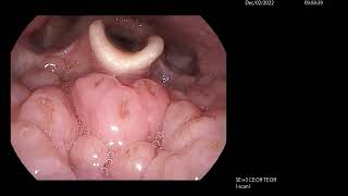 Infected Base of Tongue Lymphoid Tissue Lingual Tonsil [upl. by Brooke]