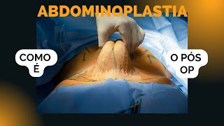 COMO É o pós operatório da abdominoplastia [upl. by Elleoj]