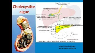 Cholécystite aiguë Cours de Hepato gastroenterologie [upl. by Almeria]