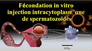 infertilité stérilité Insémination artificiel intra uterine FIV ICSI [upl. by Eelarat]