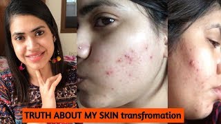 How I cleared my SKIN from ACNE amp DARK SPOTS [upl. by Ennoid]