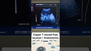 Copper T contraceptive device missed from endometrium cavity  Endometritis notedshortvideo [upl. by Ecirtaeb]