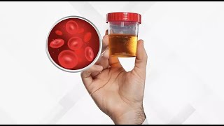 Isolated Hematuria  Definition Causes Evaluation and Management [upl. by Druci203]