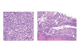 sex cord stroma steroid cell tumor and germ cell tumor of ovaryGYNpath [upl. by Bull]