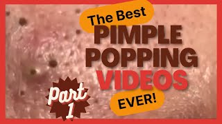 The BEST pimple POPPING videos EVER p1 [upl. by Thorma]