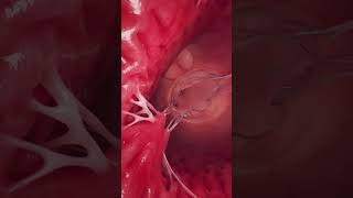 Animation of the mitral valve and left ventricle anatomy meded [upl. by Evvy]