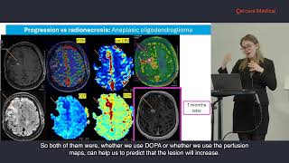 Prof Nadya Pyatigorskaya Enhancing NeuroOncology Outcomes [upl. by Hpeosj98]