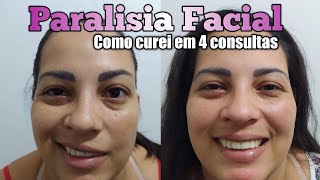 PARALISIA FACIAL CURA EM 4 SESSÕES  DR ROMULO PIMENTA [upl. by Nirret928]