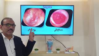 Granular myringitis English Patient teaching programme [upl. by Eirruc]