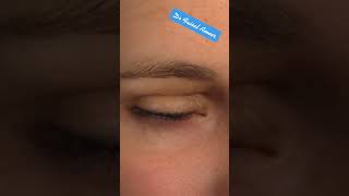 Blepharoplasty animation [upl. by Alikee]