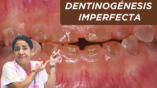 Dentinogénesis imperfecta ¿qué es ¿por qué sucede [upl. by Nauj]