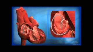 Ablation for AV Node Reentrant Tachycardia AVNRT [upl. by Fred]