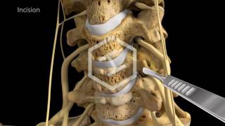 c5c6c7 Anterior Cervical Discectomy with Fusion [upl. by Hayilaa]