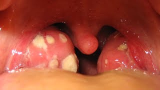 How To Remove Tonsil Stones [upl. by Moises]