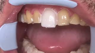 Houston Cosmetic DentistStep by step procedure for Porcelain VeneersConservative preps [upl. by Nylirac]