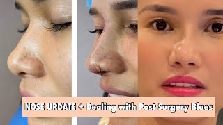 NOSE UPDATE Dealing with Post Surgery Blues After Rhinoplasty  Jen Barangan [upl. by Chernow210]