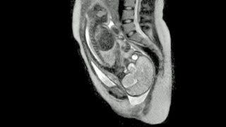 Weltpremiere in Berlin Video einer Geburt im MRT  DER SPIEGEL [upl. by Odracer]