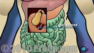 Gallbladder Removal Laparoscopic PreOp® Patient Education Feature [upl. by Ketchan829]