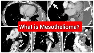 Mesothelioma of Pleura CT Chest [upl. by Vasiliki]