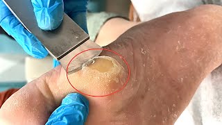 Callus removal from feetampFoot scraping dead skin【Xiao Yan pedicure】stress 809 [upl. by Alisha]