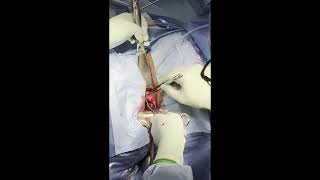 vNOTES Salpingectomy [upl. by Bullen]