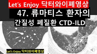 47류마톨로지폐질환류마티스관절염폐질환CTDILD폐섬유증간질성폐질환NSIP비특이성간질성폐렴rheumatologyinlung닥터와이폐영상폐섬유화사진자가면역질환 [upl. by Dell660]