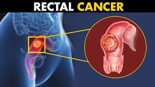 What Happens In Rectal Cancer  Symptoms Causes And Treatment [upl. by Airitac]