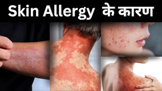 Skin Allergy  Skin Allergy का कारण  Skin Infection  skinallergy mayankjaiswal [upl. by Hertberg]