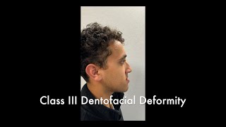 Bimaxillary Osteotomy and Genioplasty Part 1 [upl. by Ennairol]