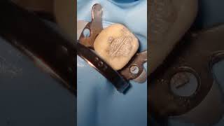 Amalgam Filling Procedure  Step by Step [upl. by Nodab]