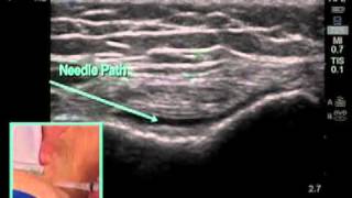 How to Ultrasound Guided Knee Injection Scanning Technique [upl. by Renelle]