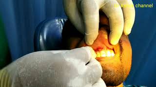 Dental infectionincision and drainage of dentoalveolar abscess [upl. by Arbmahs92]