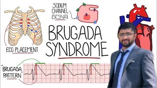 Brugada Syndrome ECG Brugada pattern Brugada pattern on ECG [upl. by Mattheus]