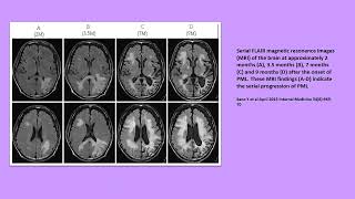 Neurology Quiz 95 Progressive multifocal leukoencephalopathy PML [upl. by Amr]