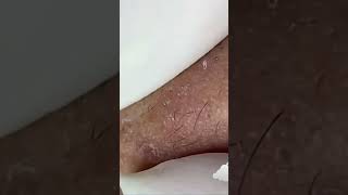 Pimple Popping ASMR [upl. by Rabush]