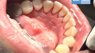 Periodontal treatment protocol [upl. by Schreib60]